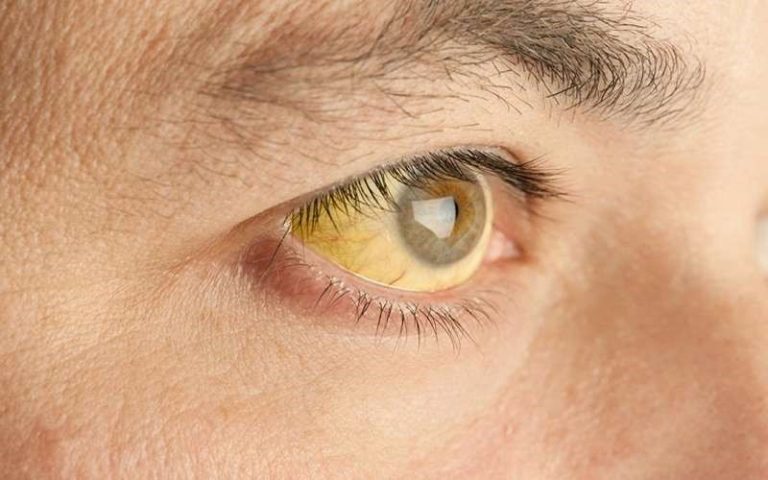 بیماری تب زرد چیست؟