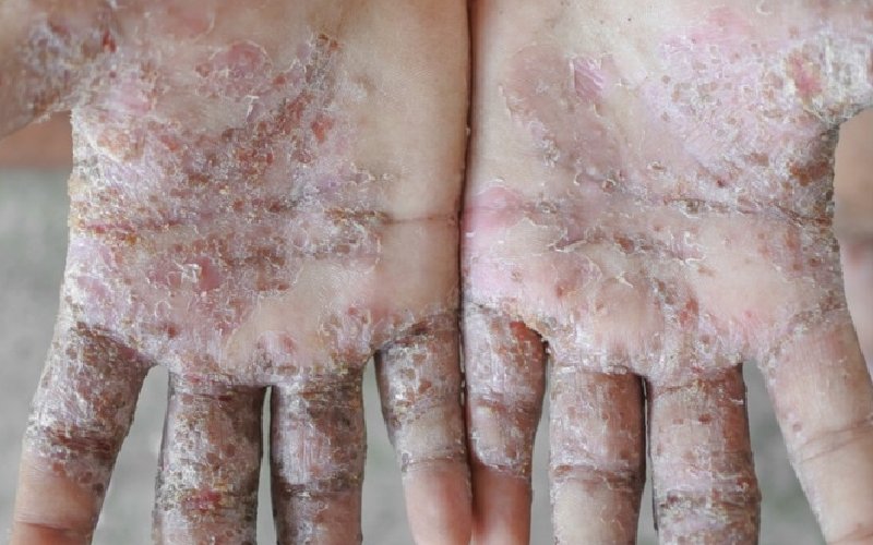 درمان بیماری جرب