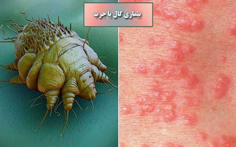 بیماری گال چیست ؟ علائم انواع جرب چیست ؟