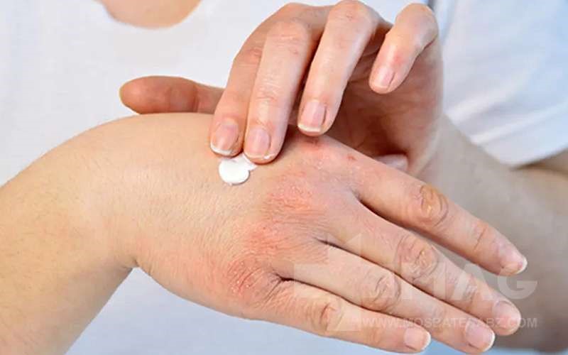 خواص پماد هیدروکورتیزون چیست