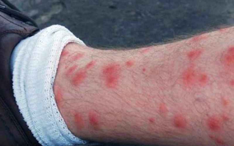 بهترین سم برای از بین بردن ساس چیست