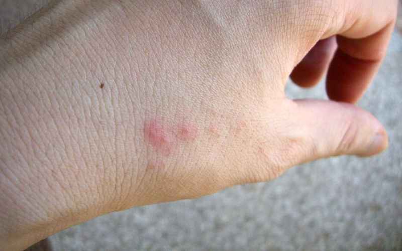 خطرات سم پشه کش