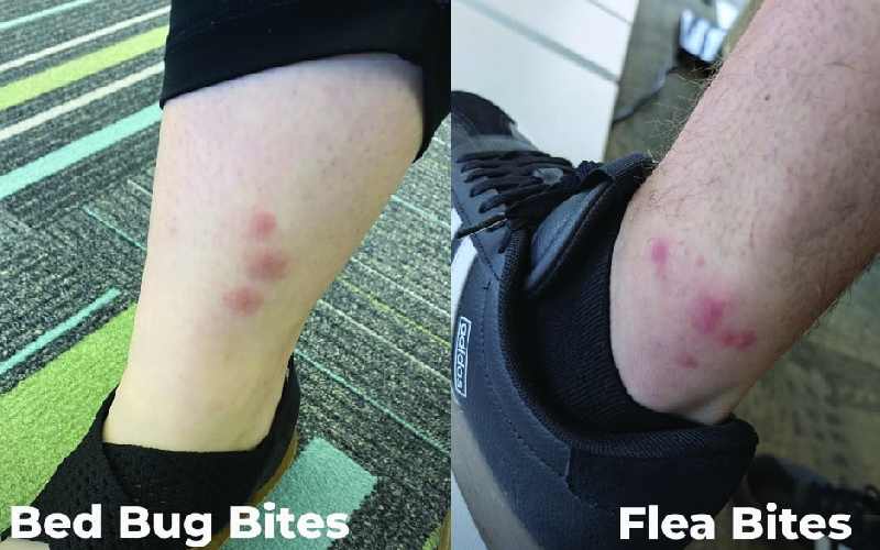 تشخیص سریع بین گزش ساس و کک