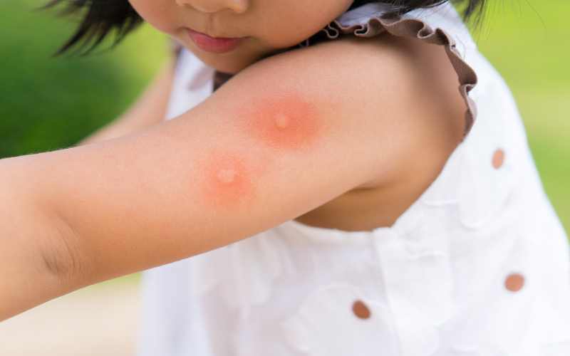 فواید نیش پشه برای انسان