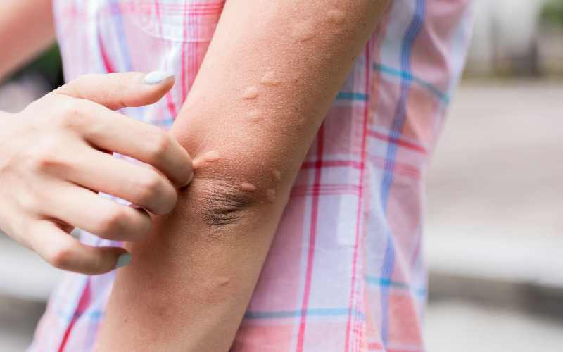 چرا جای نیش پشه ورم می‌کند