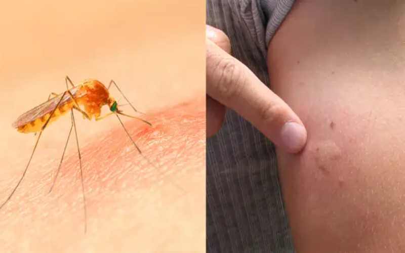 چرا جای نیش پشه سفت میشود