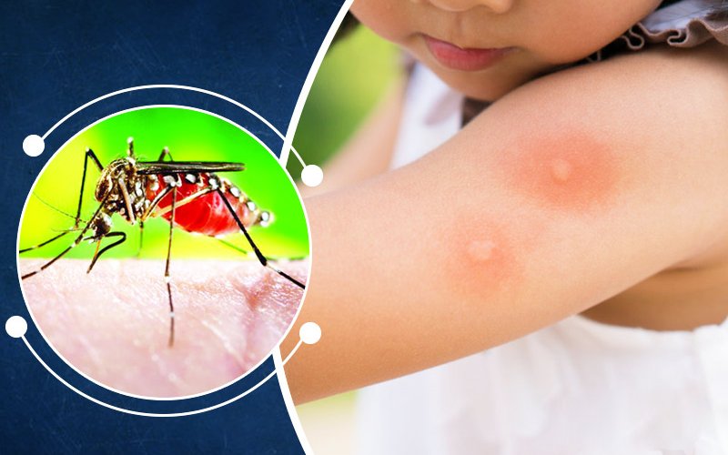 درمان نیش پشه آئدس