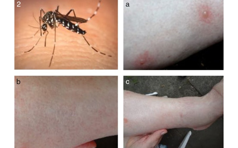 درمان جای نیش پشه آئدس