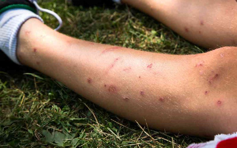 بهترین راه درمان نیش پشه آئدس