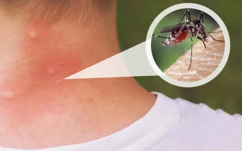 نیش پشه آئدس