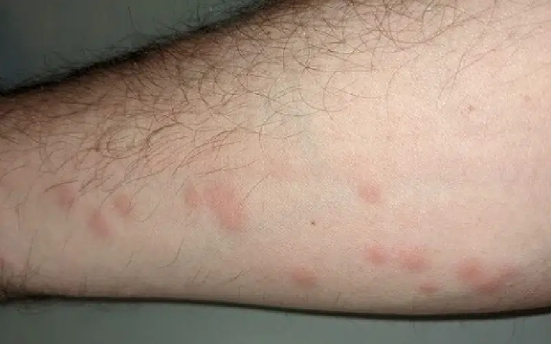 جای نیش پشه آئدس چه شکلی است