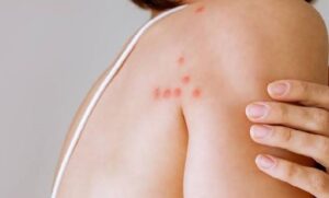 جای نیش ساس معمولا در کدام قسمتهای بدن دیده میشود؟