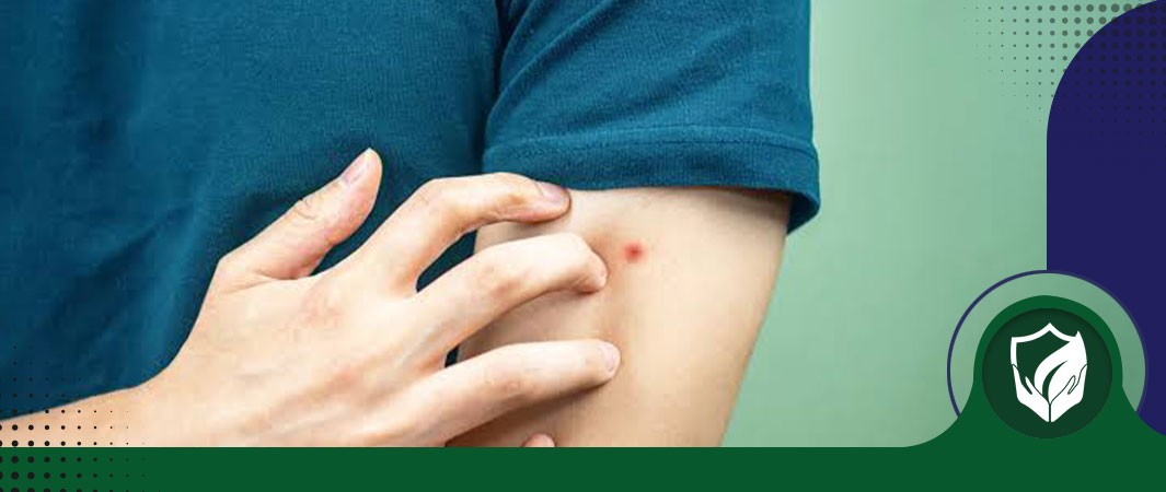 چطور نیش ساس را تشخیص دهیم؟ + راه درمان